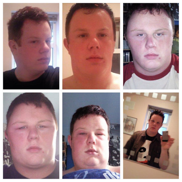 Visages gonfls piqre - 1