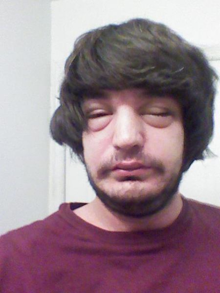 Visages gonfls piqre - 10