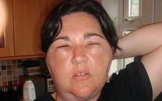 Visages gonfls piqre - 16