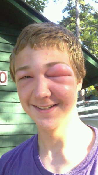 Visages gonfls piqre - 3