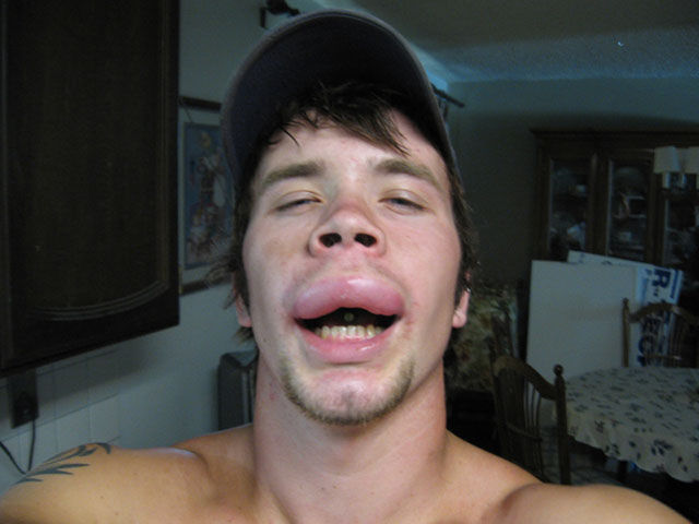 Visages gonfls piqre - 4