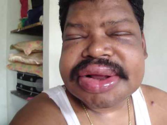 Visages gonfls piqre - 7