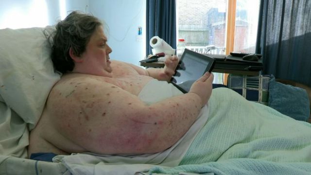 La radiographie d'un homme obèse - 1