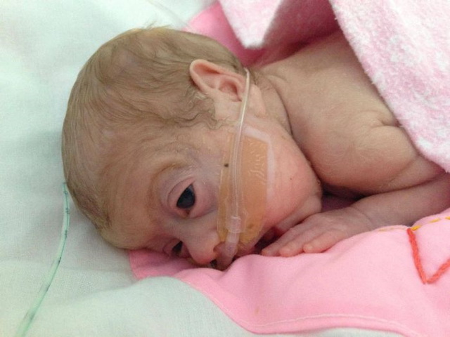 Photos d'un bb prmatur - 17