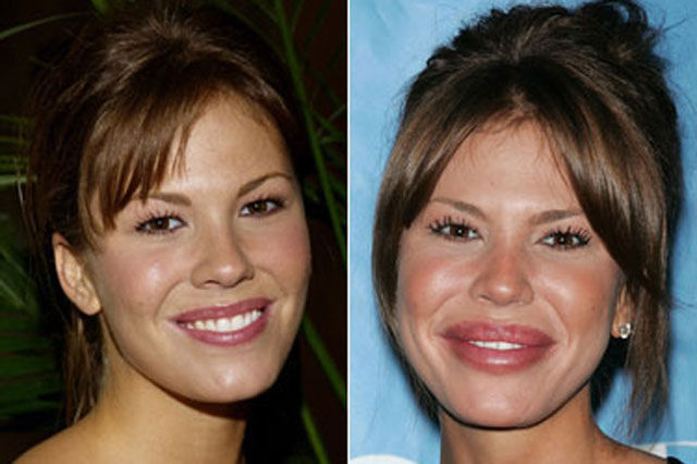 La chirurgie esthtique est dangereuse - 15